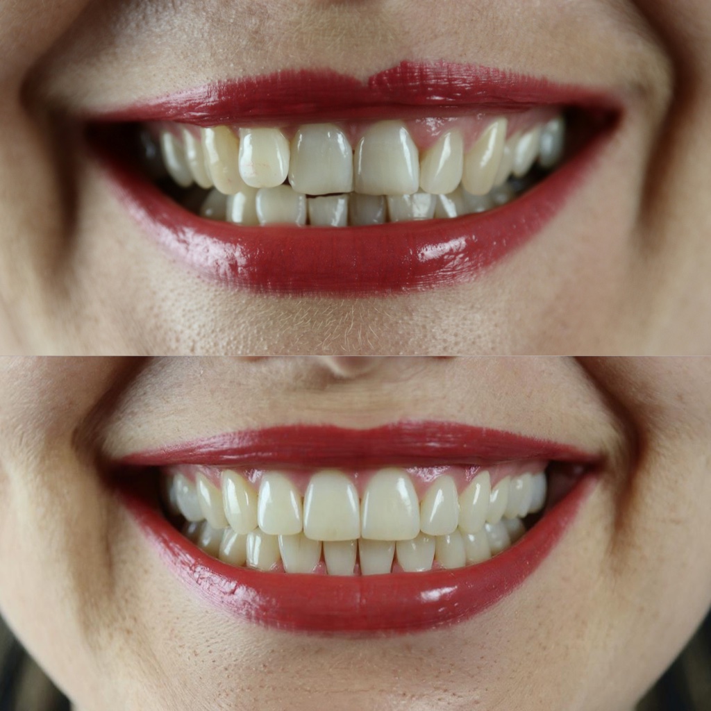 Perfect Teeth - AI Photo Enhancement Tool